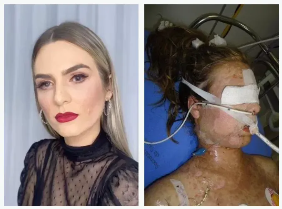澳洲止痛藥出事！女子服後昏迷17天，皮膚損毀雙眼失明！